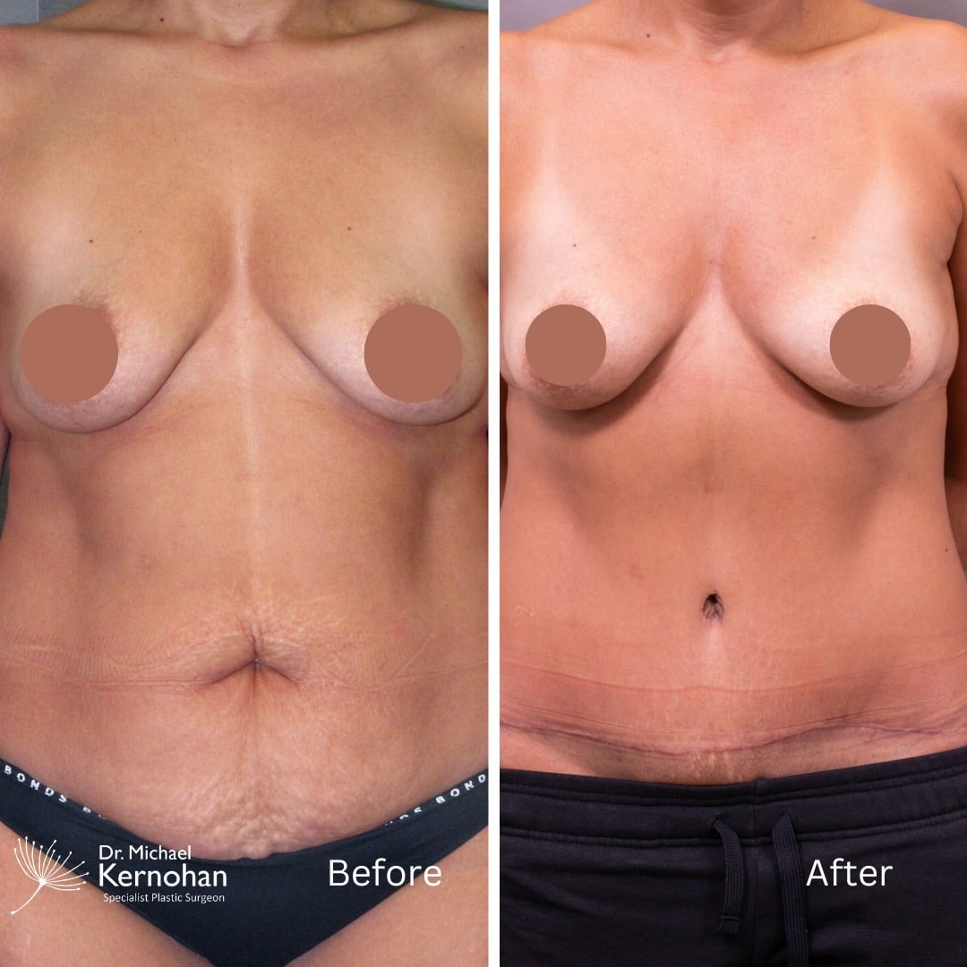 Fat Transfer to Breasts Sydney - Dr Michael Kernohan Plastic Surgeon