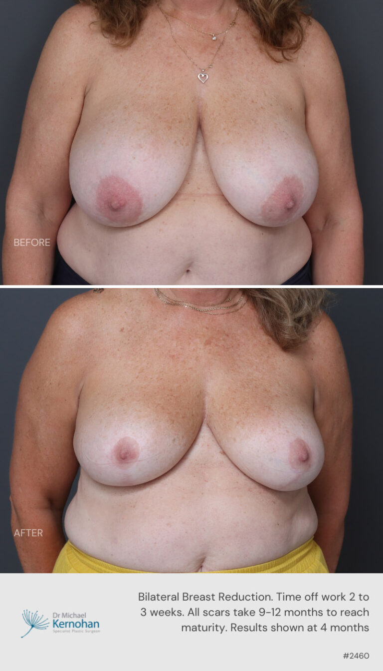 Breast Reduction Before and After 