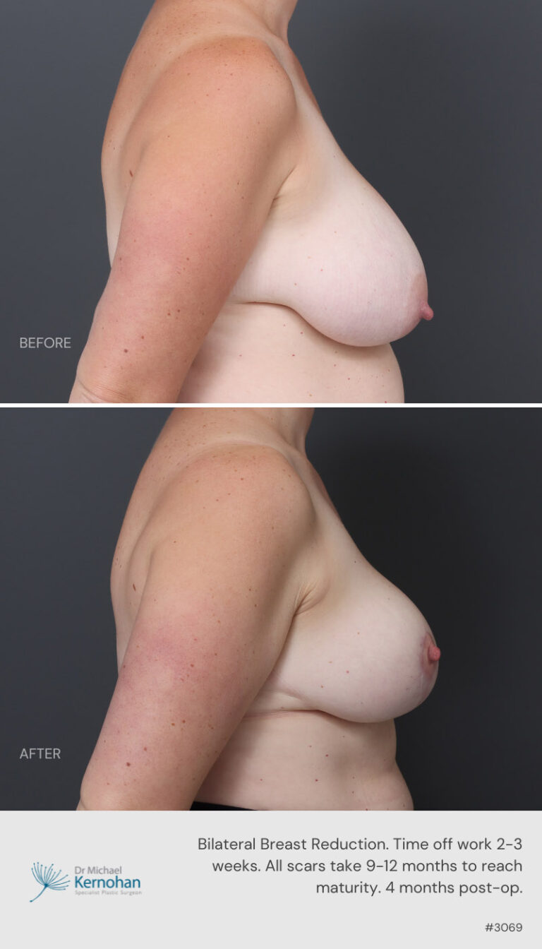 Breast Reduction Before and After 