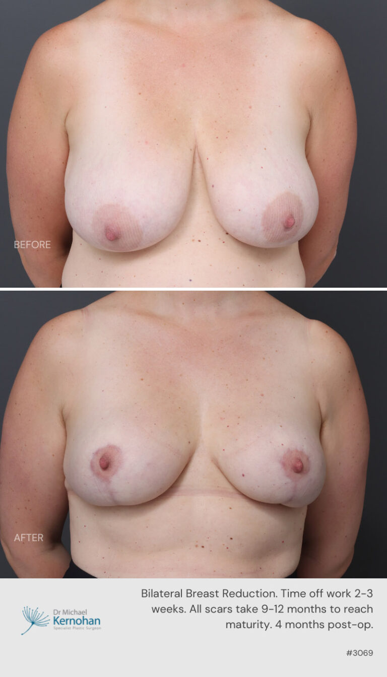 Breast Reduction Before and After 