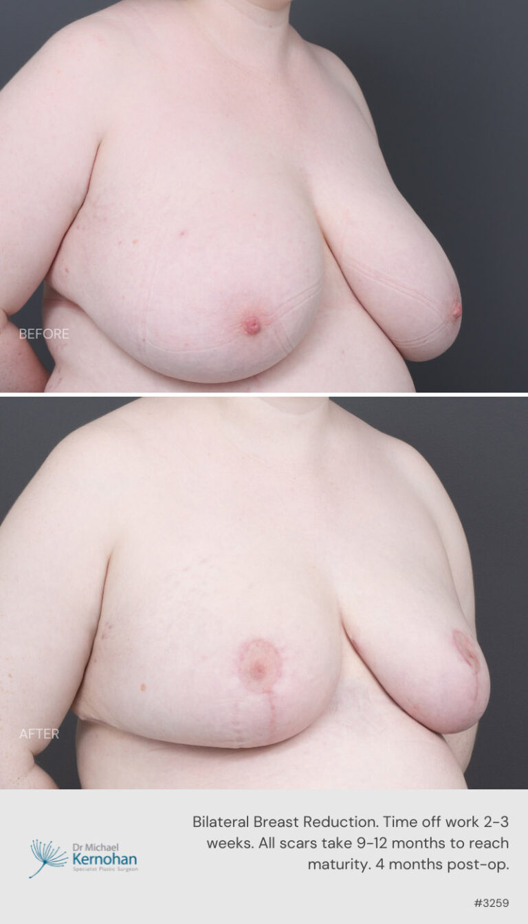 Breast Reduction Before and After 