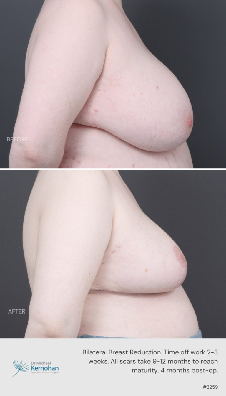 Breast Reduction Before and After 