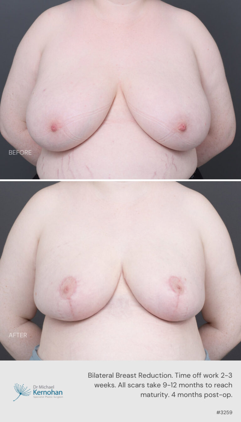 Breast Reduction Before and After 