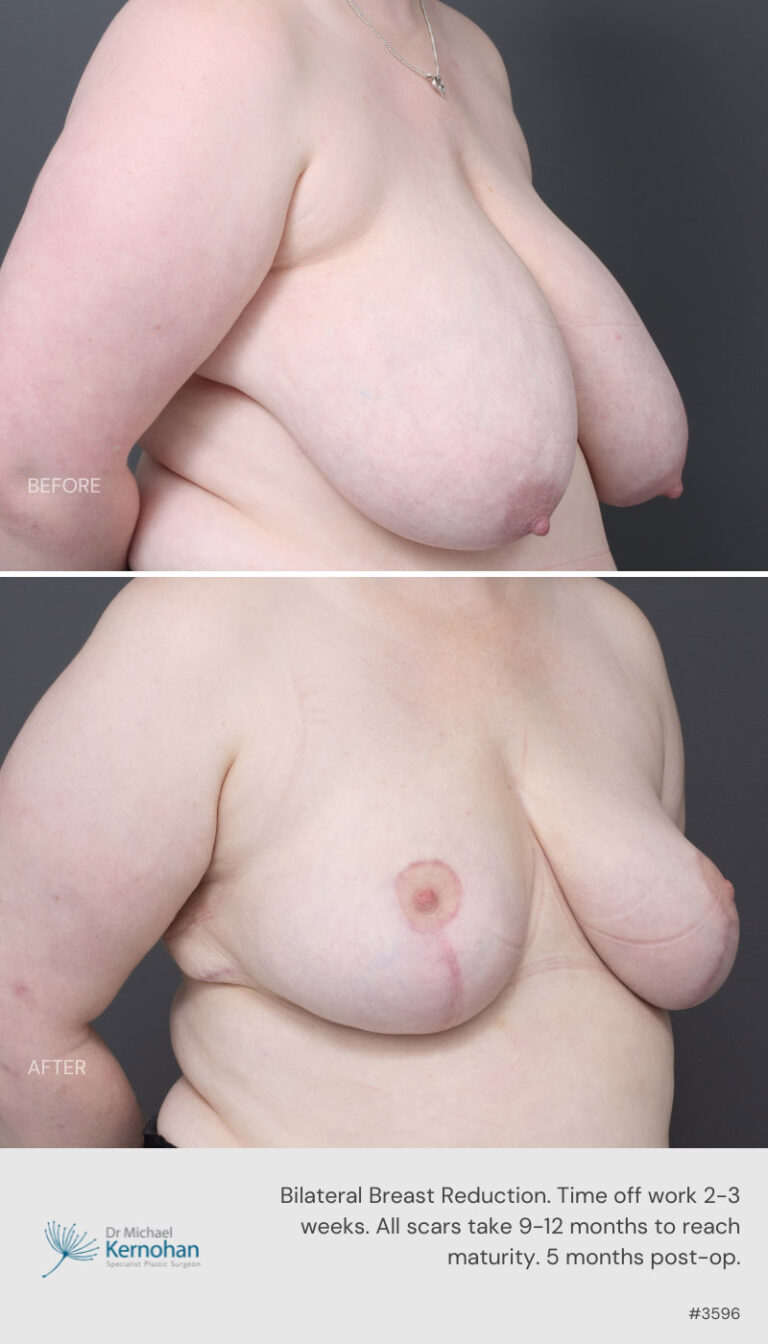 Breast Reduction Before and After 