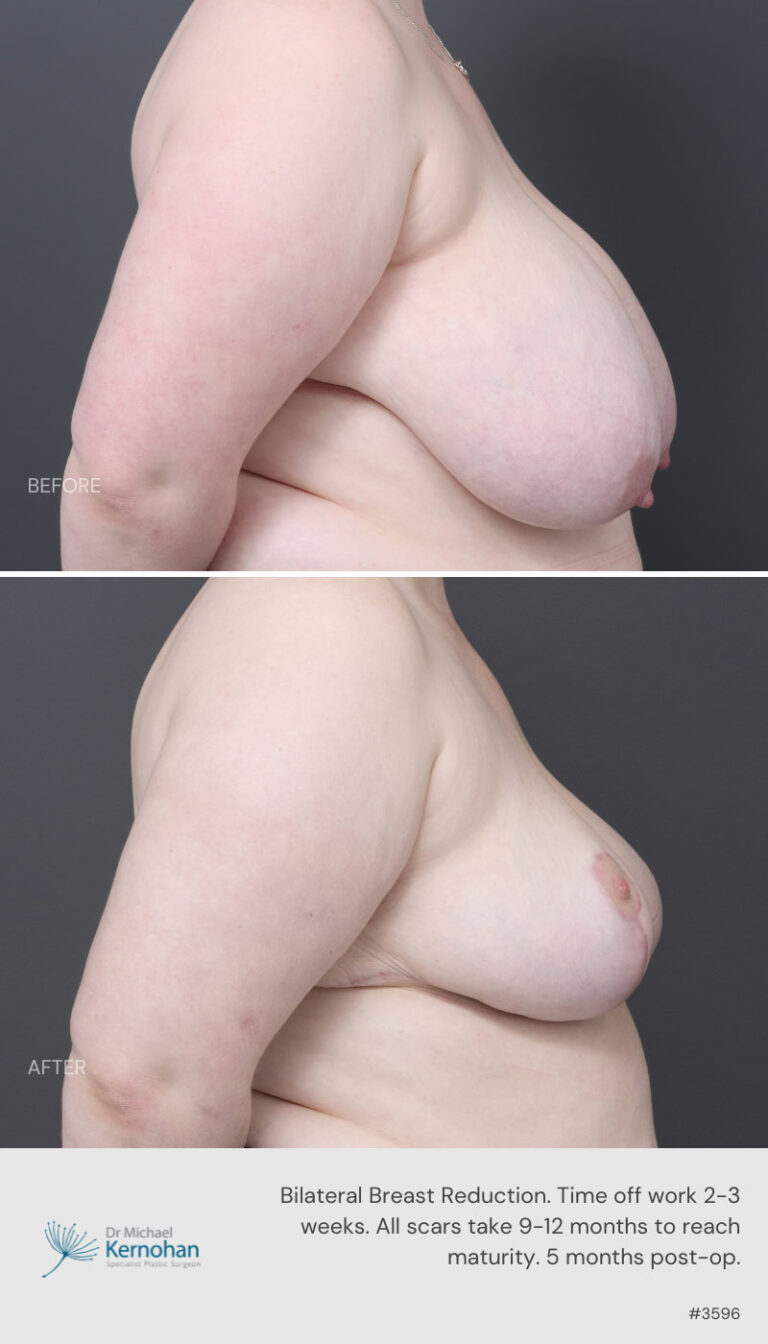 Breast Reduction Before and After 