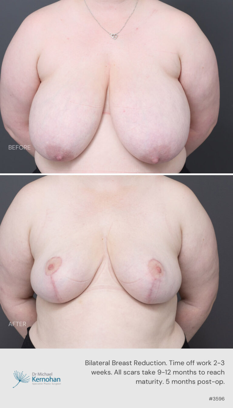 Breast Reduction Before and After 