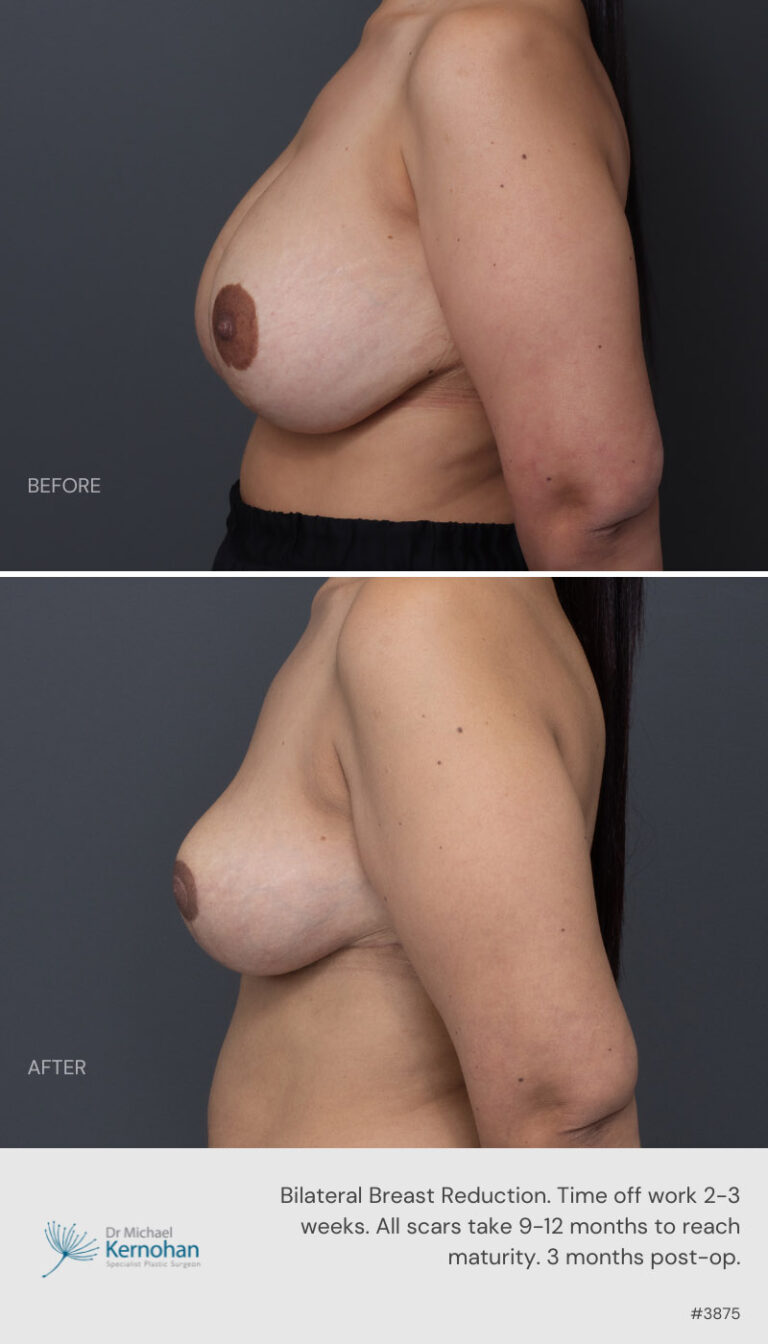 Breast Reduction Before and After 