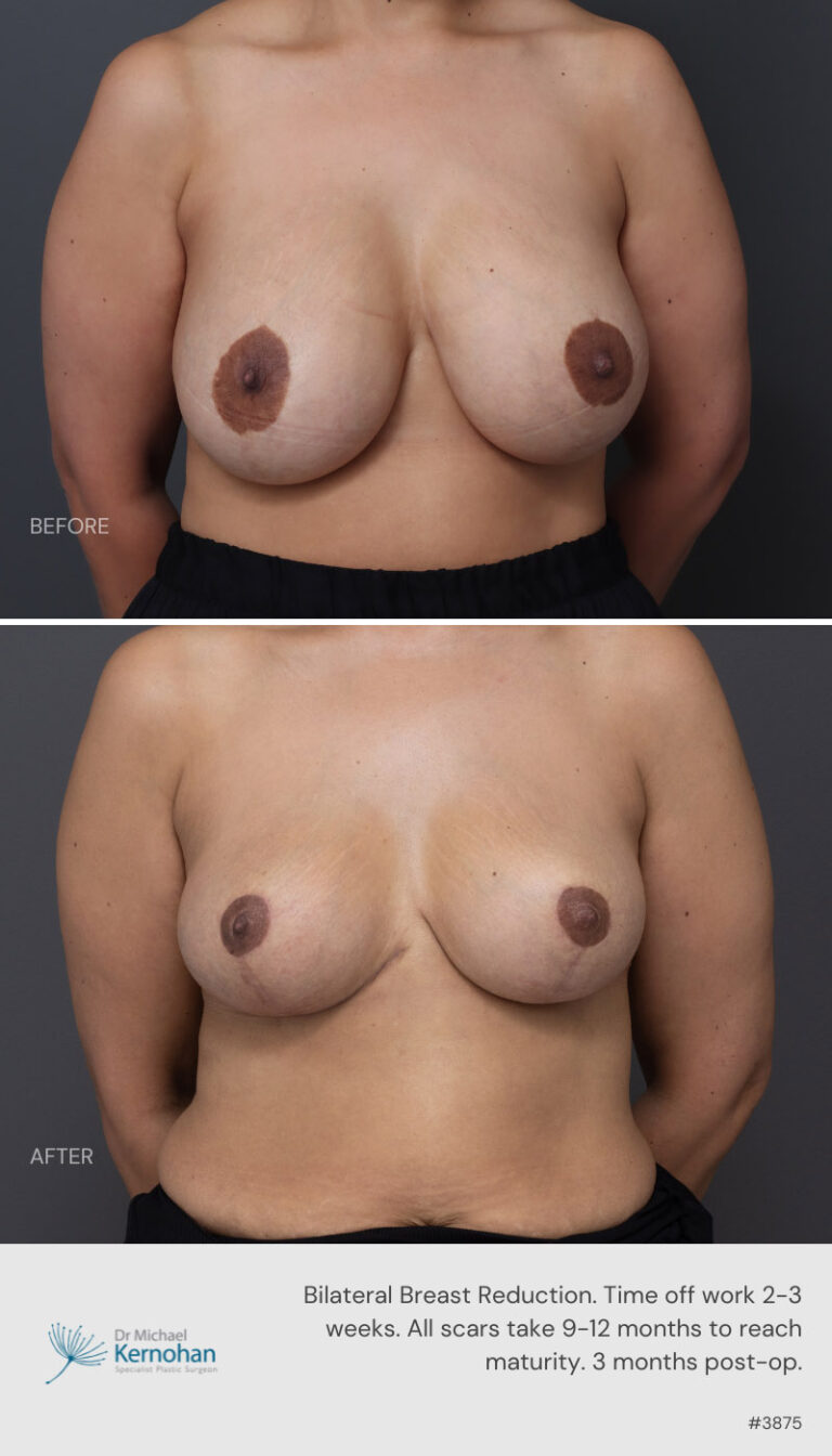 Breast Reduction Before and After 