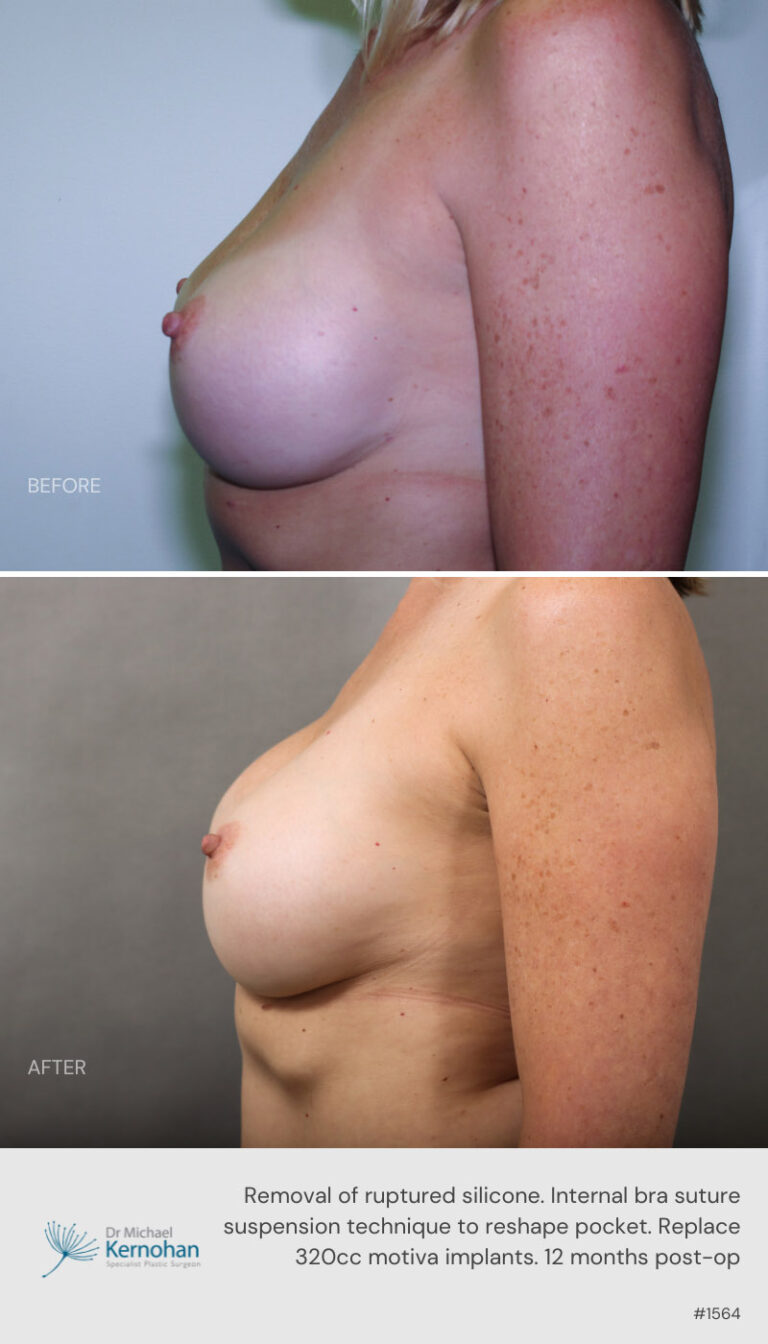 Breast Implant  Exchange Before and After Template 800 x 1400 -