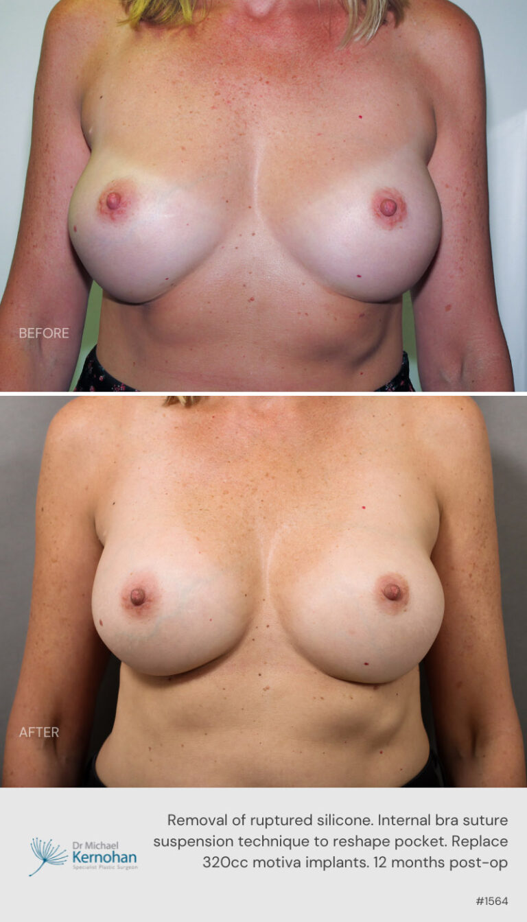 Breast Implant  Exchange Before and After 