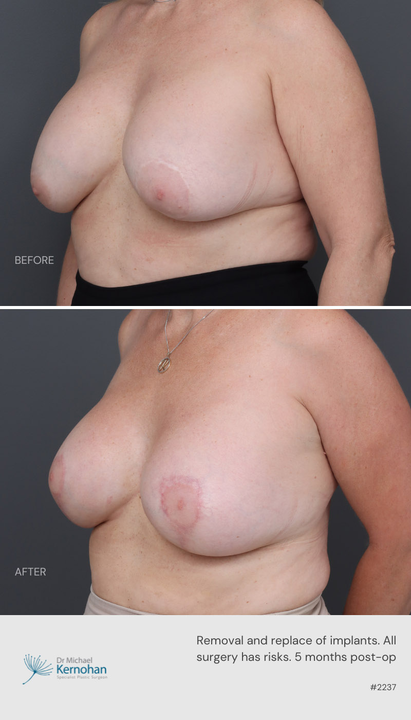 Breast Implant Exchange Before and After - 5 months post op - facing 45 degree right