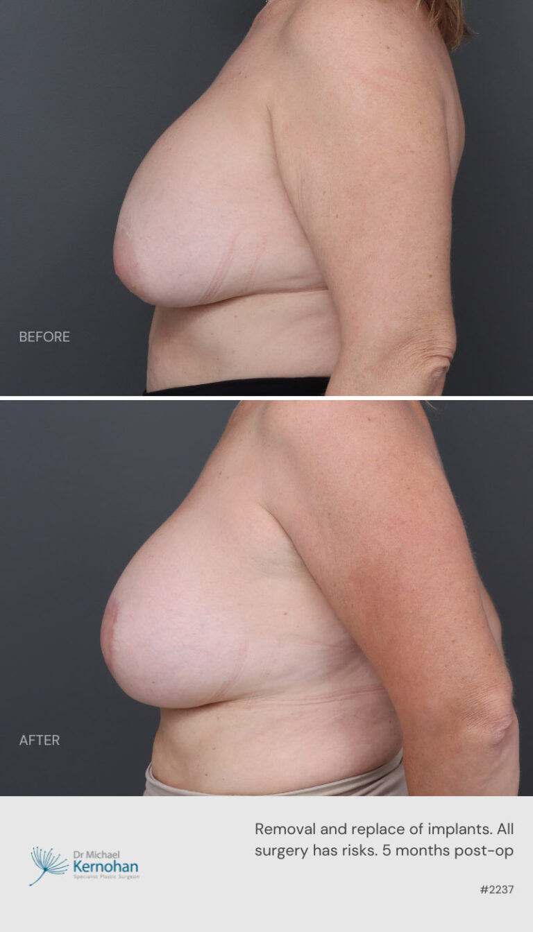 Breast Implant  Exchange Before and After 