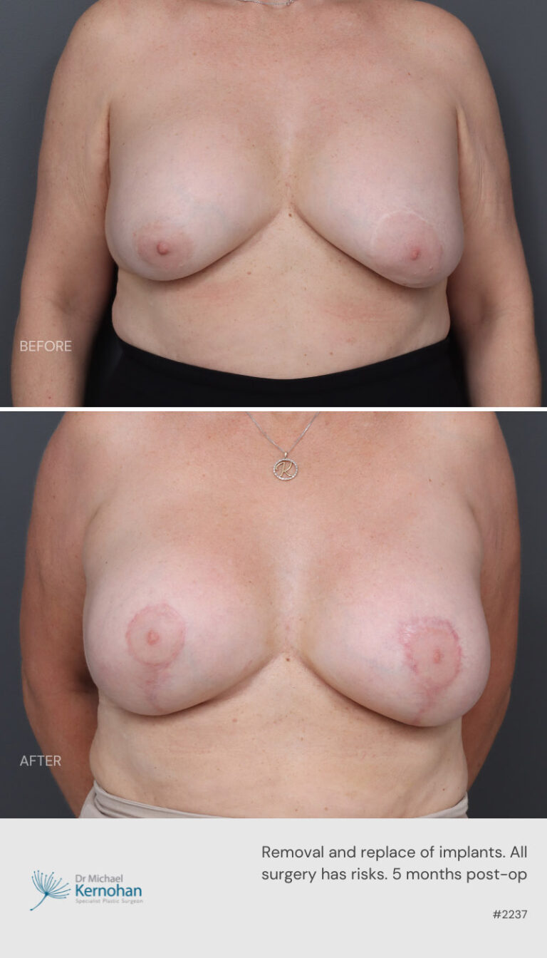 Breast Implant  Exchange Before and After 